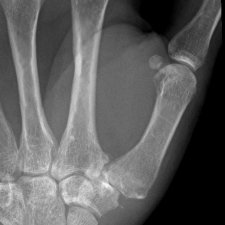 Preoperative PA X-ray zoomed on the thumb CMC joint — joint space narrowing, sclerosis, and dorsal subluxation.