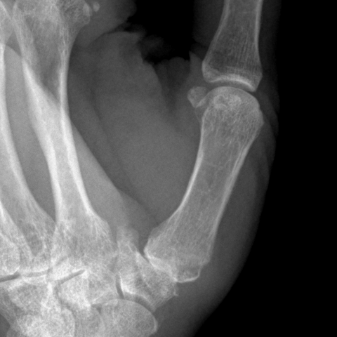 Preoperative oblique X-ray zoomed on the thumb CMC joint — osteophytes and loss of joint space at the base of the thumb.